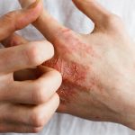 Remèdes naturels efficaces contre l’eczéma : Guide complet pour soulager votre peau