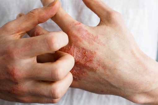 Remèdes naturels efficaces contre l’eczéma : Guide complet pour soulager votre peau